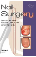 Nail Surgery