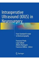 Intraoperative Ultrasound (IOUS) in Neurosurgery